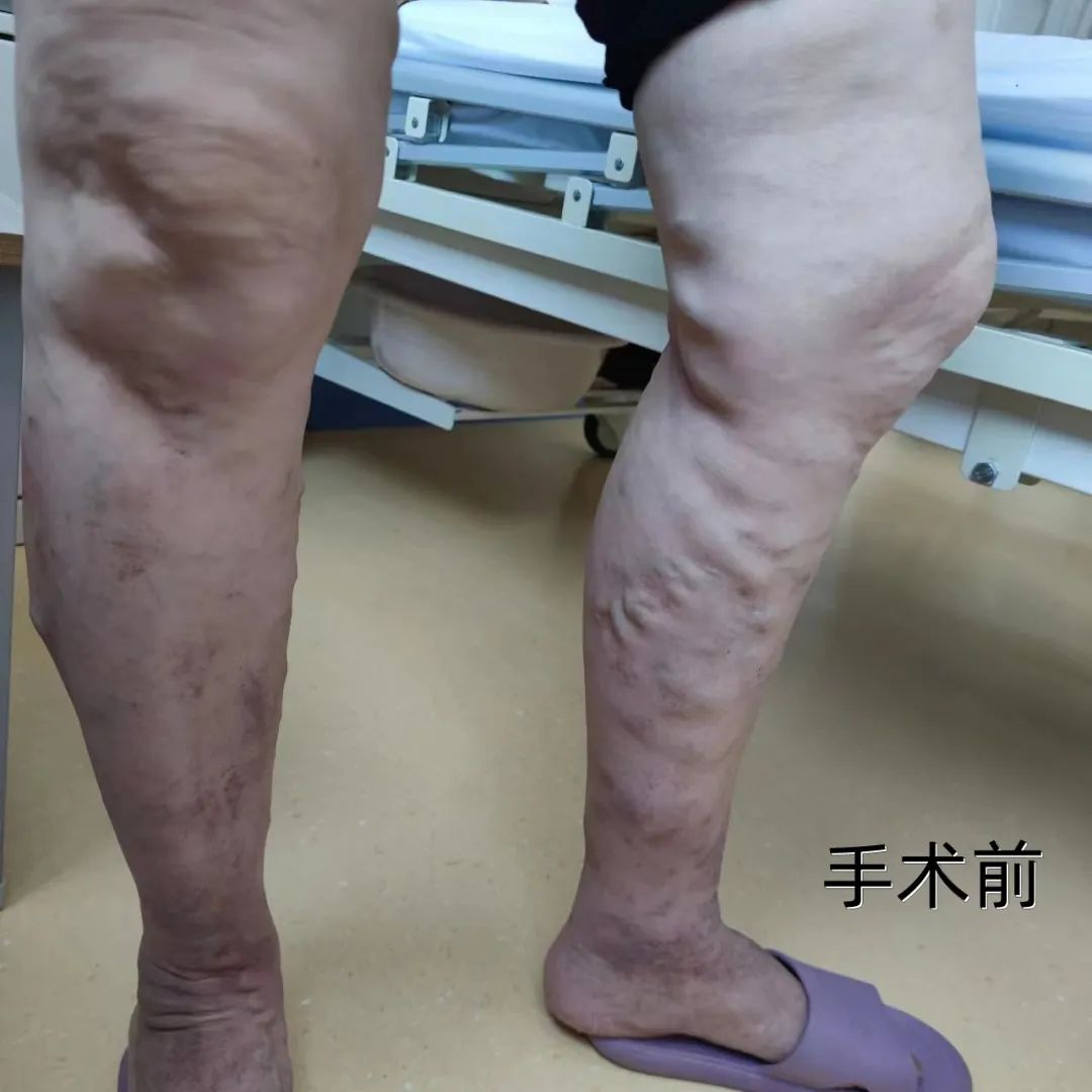 静脉曲张微创是打硬化剂么,可视微创治疗静脉曲张