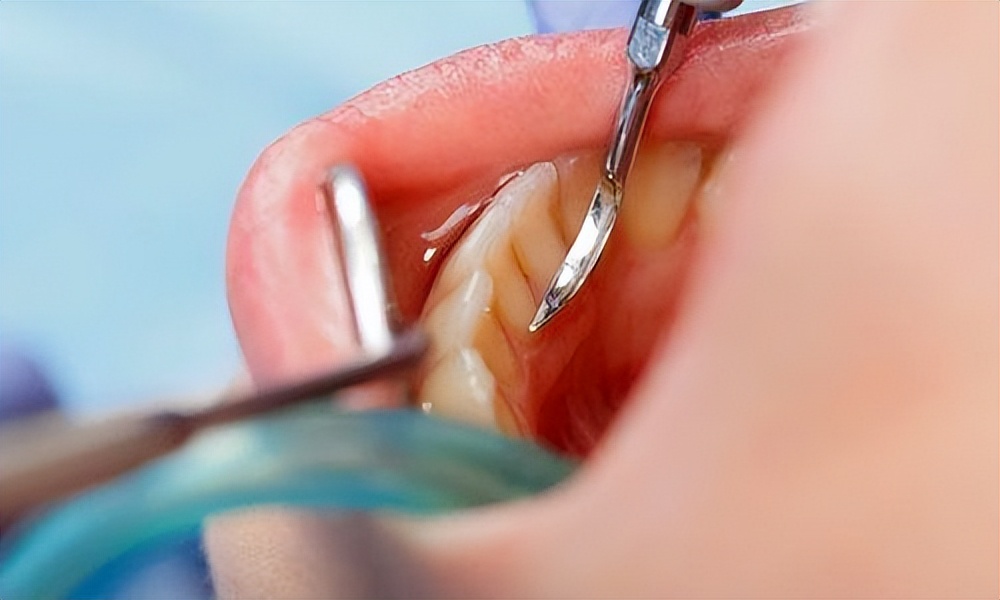 牙结石能直接抠下来吗,牙结石用手可以抠掉吗