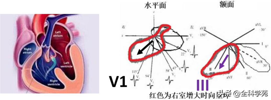 心电图笔记26：QRS波振幅变高，需要想到哪些