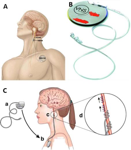 癫痫治疗最好的办法是什么,癫痫治疗最有效的办法有哪些