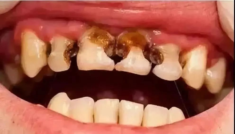 什么样的可乐牙需要治疗,健康科普温馨提示信息