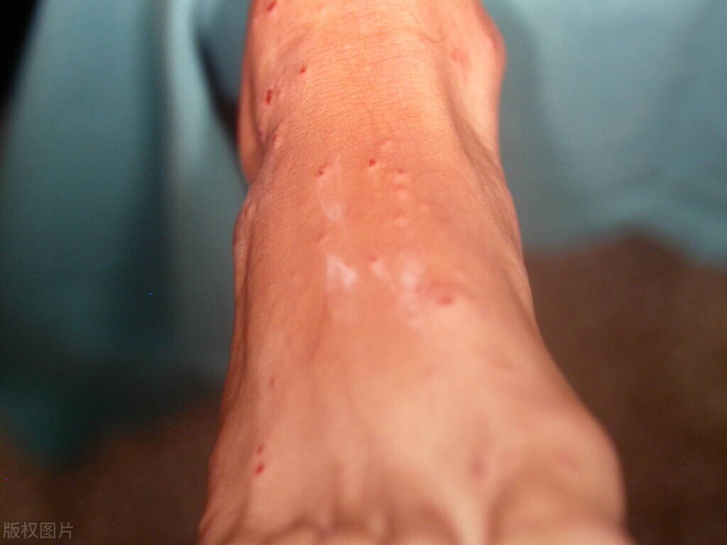 早期艾滋会出现什么皮肤病,不要错把艾滋当皮肤病