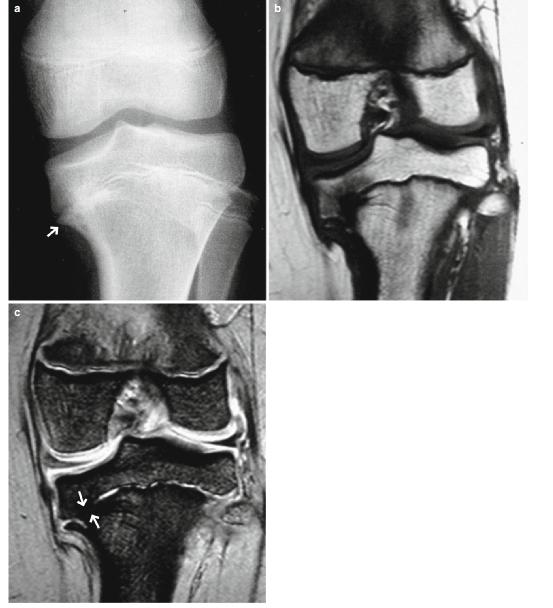 胫骨内翻与先天性前交叉韧带缺失磁共振诊断