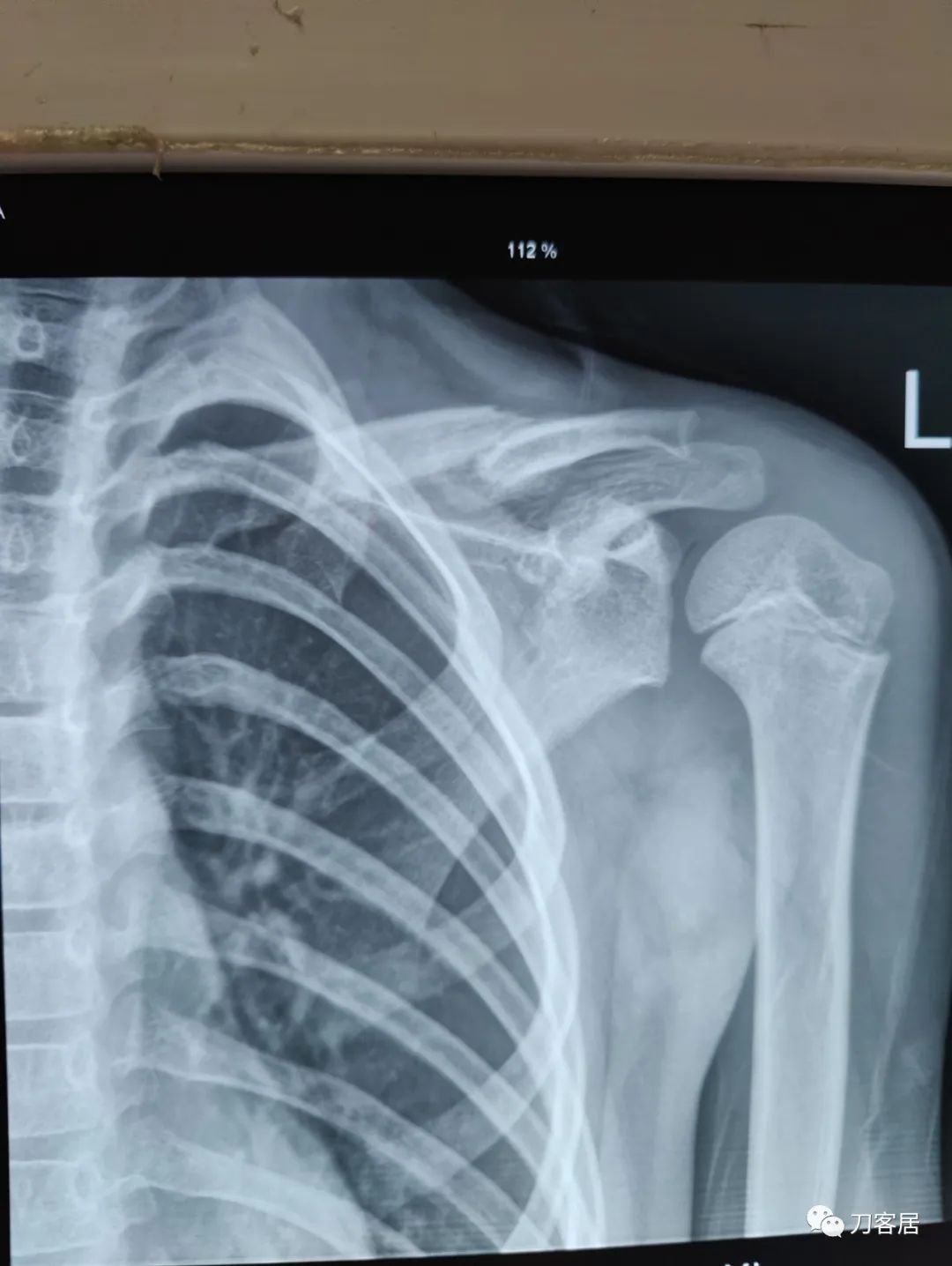 儿童锁骨骨折保守治疗的弊端,锁骨粉碎骨折错位不处理会愈合吗