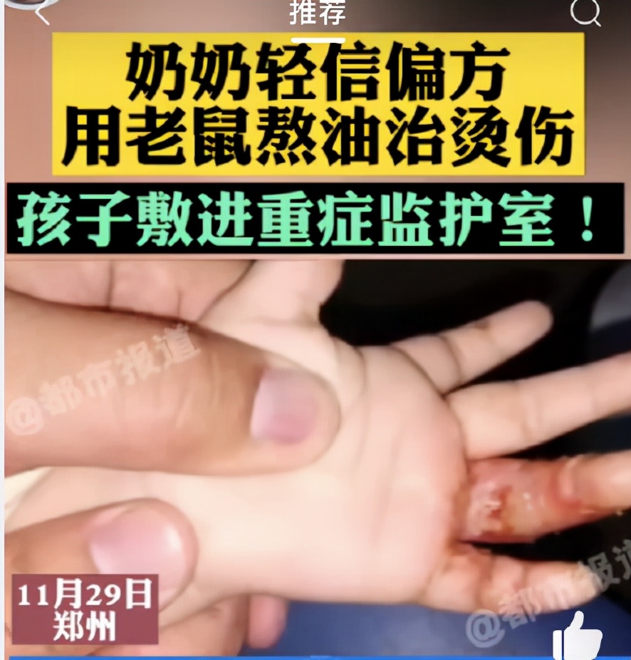 香油泡癞蛤蟆可以治烫伤吗,癞蛤蟆灌石灰治烫伤