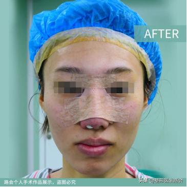 隆鼻后如何度过第一个月,隆鼻恢复期如何调整心态