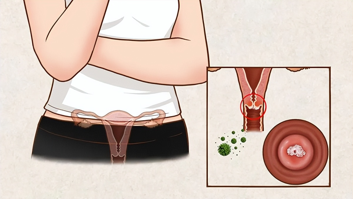 女阴道损伤多久能痊愈,最伤阴道的四种不良习惯