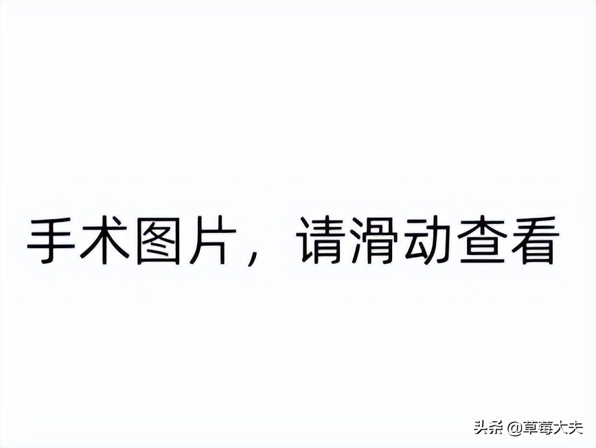 肚子莫名长大！40岁姐姐取出柚子大肿瘤，一查是肠道癌症跑到卵巢