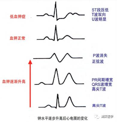 血钾危急,高钾血症危急值记录