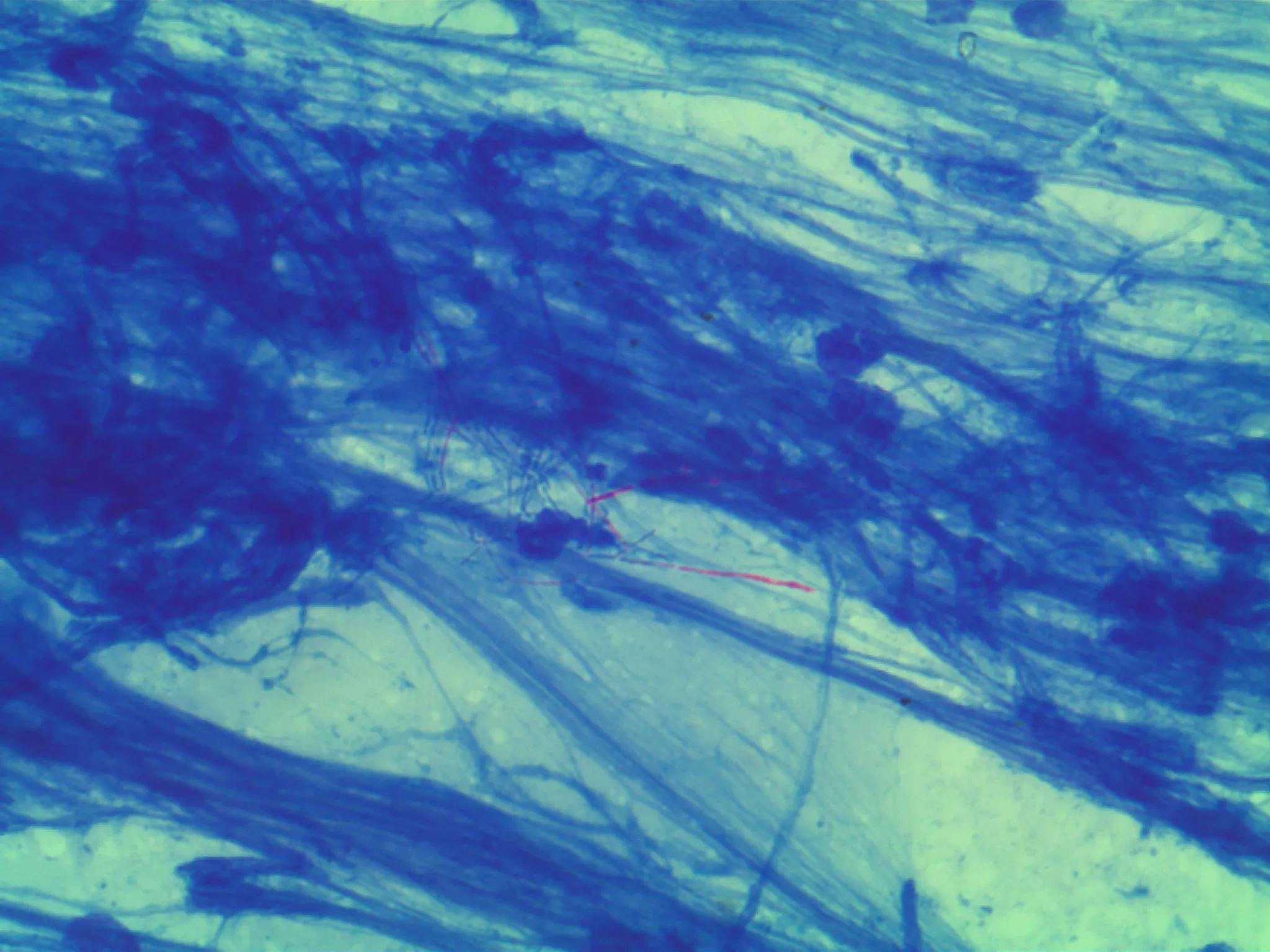 奴卡菌和结核菌,奴卡菌属于非结核分枝杆菌吗