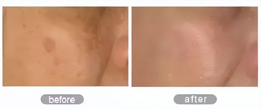 韩国东星小黑瓶祛斑霜，​韩国东星制药60年口碑企业出品！