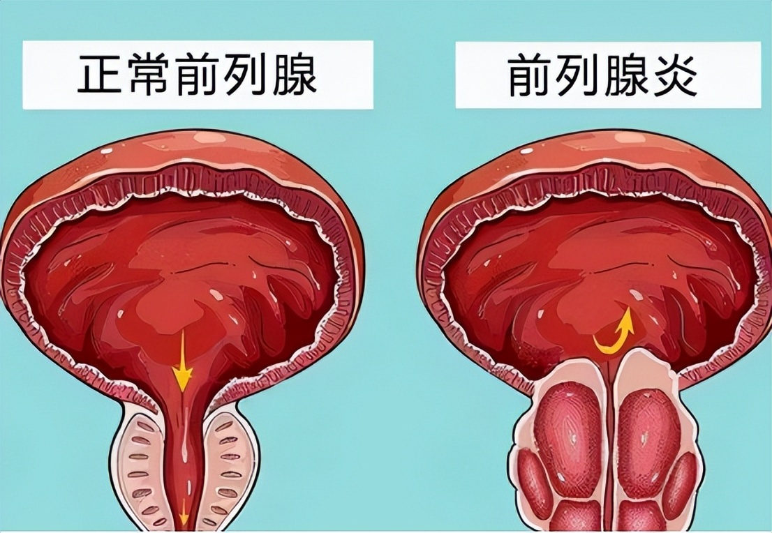 36岁的男性前列腺炎发病率有多高,前列腺炎病因及发病机制