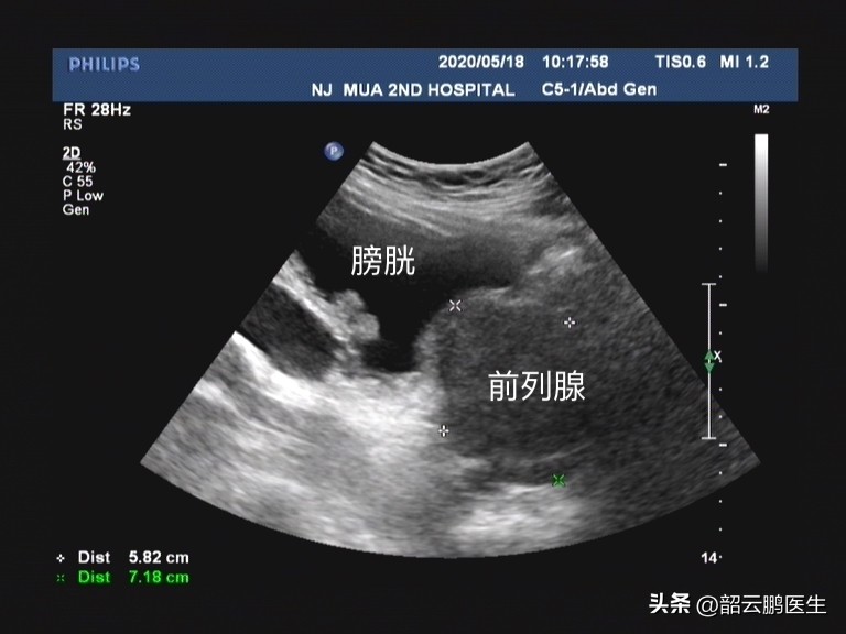 前列腺增生服用坦索罗辛效果不好,前列腺增生吃坦索罗辛能治好吗