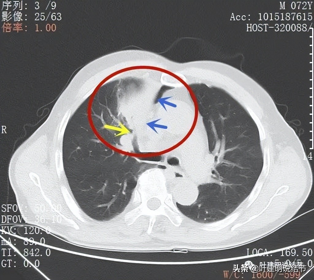 经验：肺占位超6厘米，不是癌还会是什么？临床上仍得多个心眼