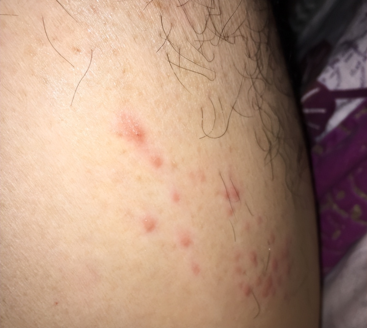 艾滋病腋下肿块,女子洗澡发现腋窝肿块