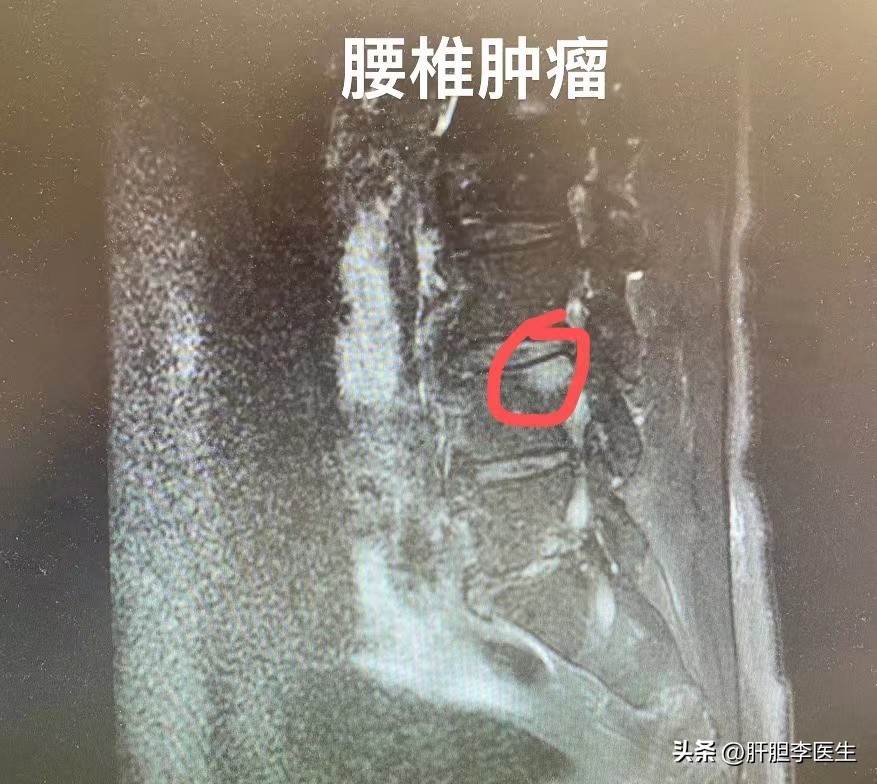 腰疼三个月以上要做哪些检查,腰疼体检发现肾癌是晚期吗