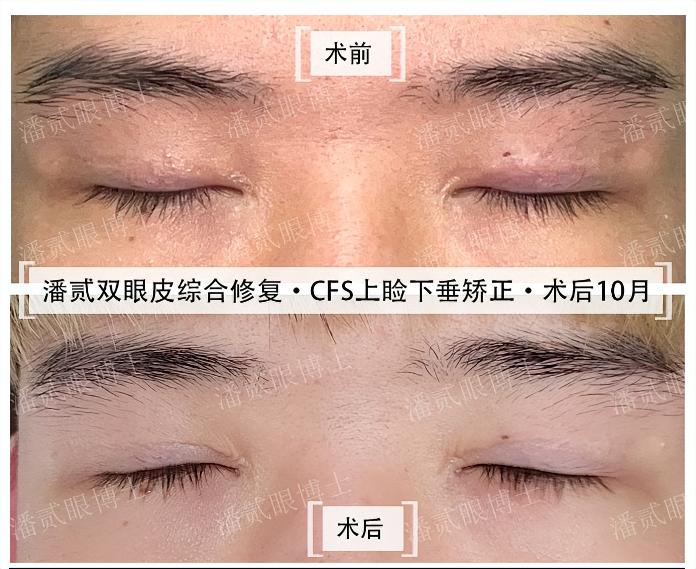 割双眼皮就割一只眼,割双眼皮提肌有风险吗