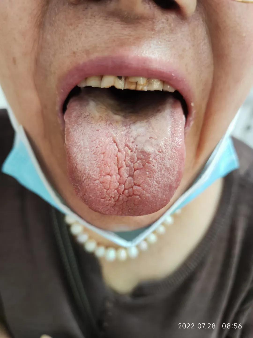 口服中药3个月，确诊5年的干燥综合征患者病情明显缓解