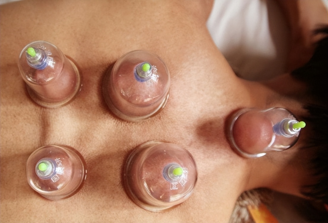 拔火罐吸出来的淤血，是体内的毒素？告诉你真相，看完涨知识