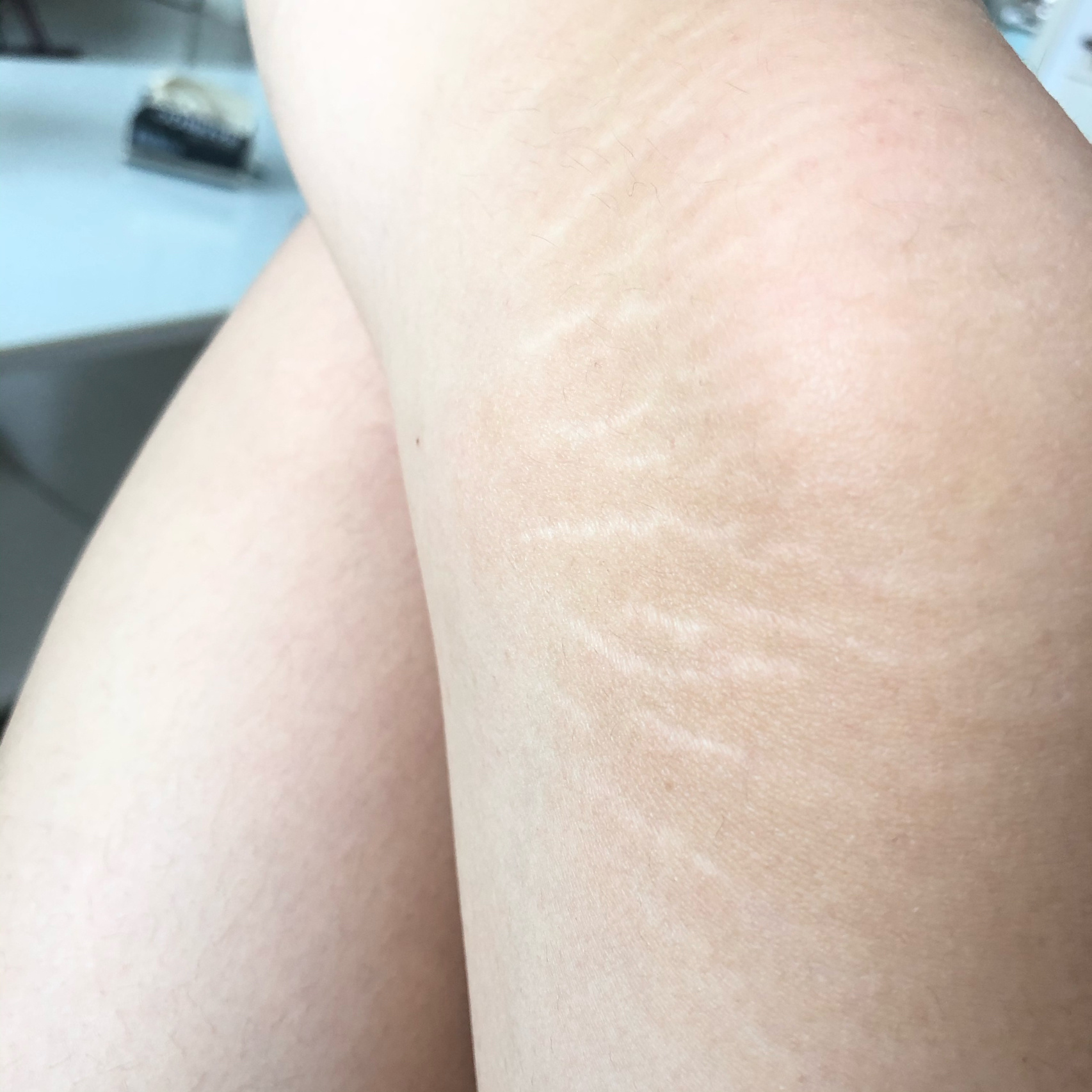 胳膊和大腿上的肥胖纹怎么能消掉,大腿有肥胖纹有十年了还能去掉吗