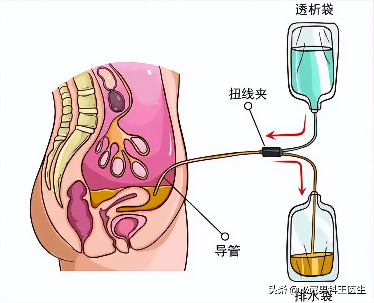 尿毒症注意三个坏习惯,为何尿毒症越来越多医生直言