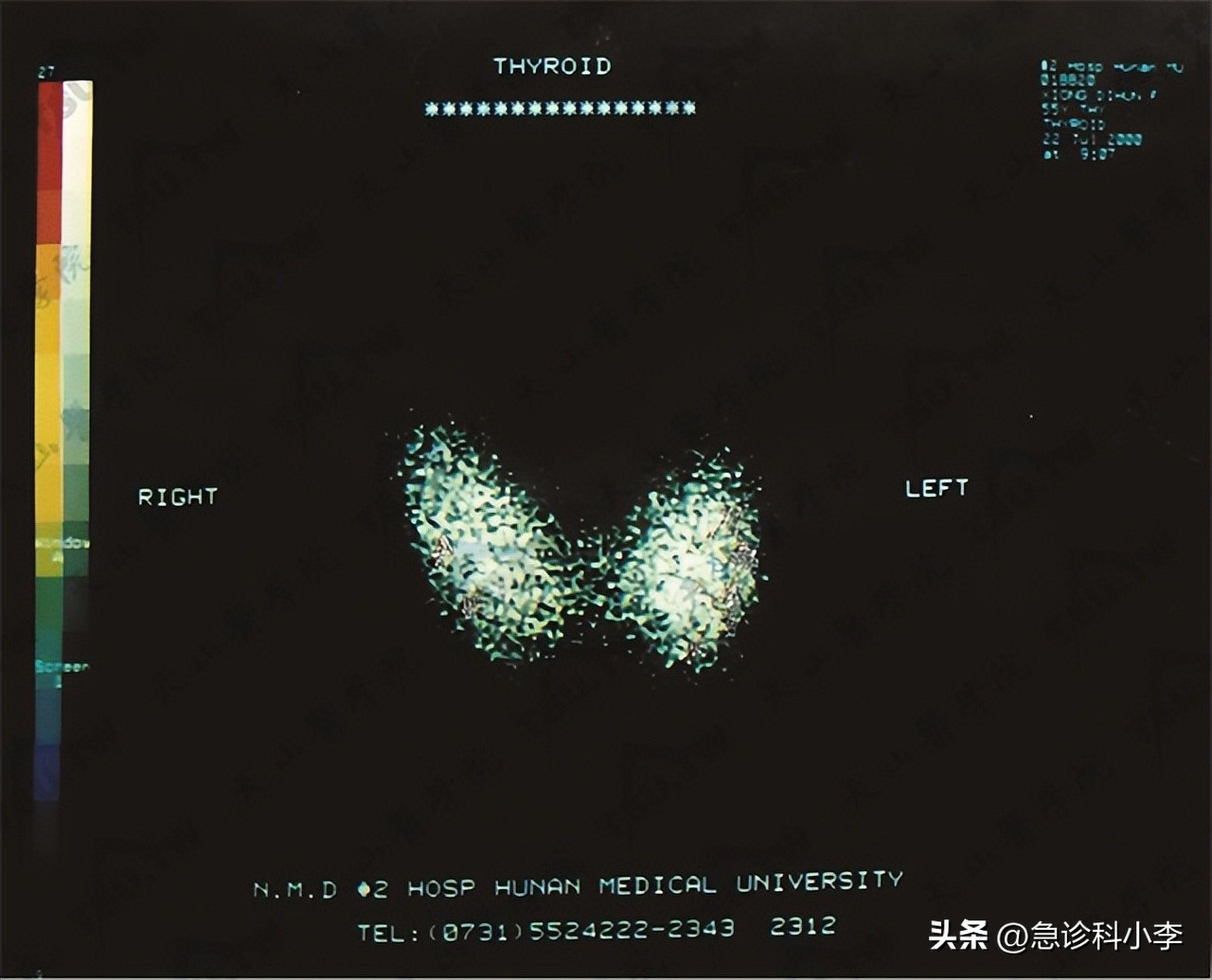 甲状腺实性结节4a癌变几率有多大,长了甲状腺结节癌变的几率有多大