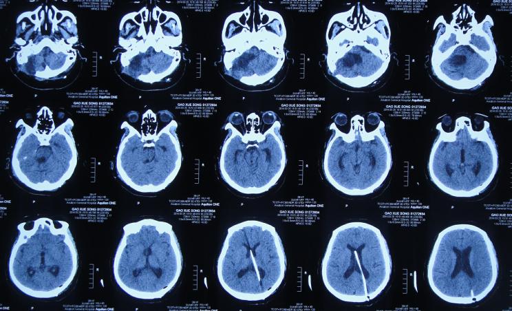 听神经瘤出现脑积水和出血,听神经瘤手术后颅压高症状