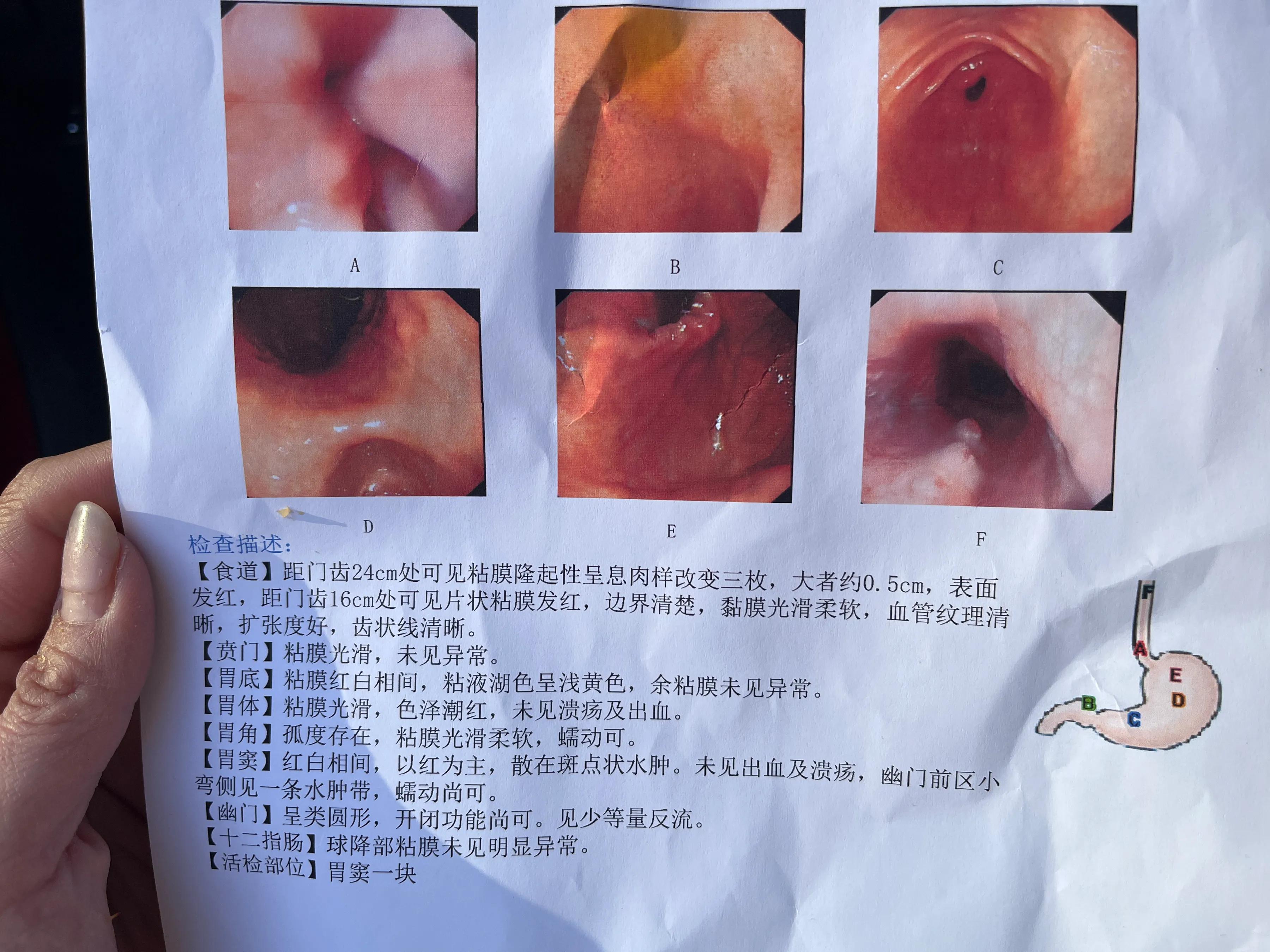 无痛胃镜和普通胃镜检查全过程,无痛胃镜检查全过程真实版