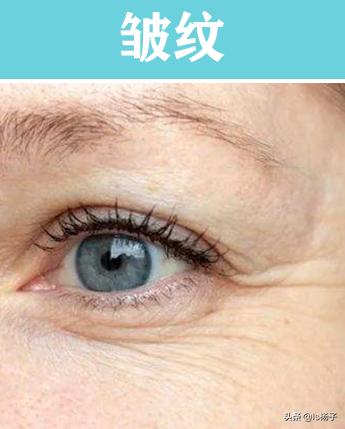 干纹细纹怎么去除最好,皱纹细纹和干纹的区别及解决方法