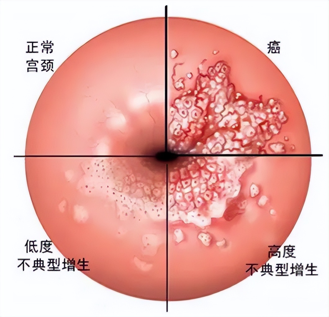感染hpv导致宫颈癌还能治好吗,感染hpv导致癌变的几率