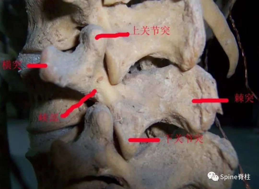 轻度峡部裂和重度峡部裂的区别,真性峡部裂和假性峡部裂