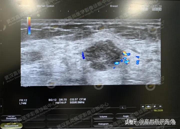 乳腺超声病例,乳腺肿块巨大超声结果4a