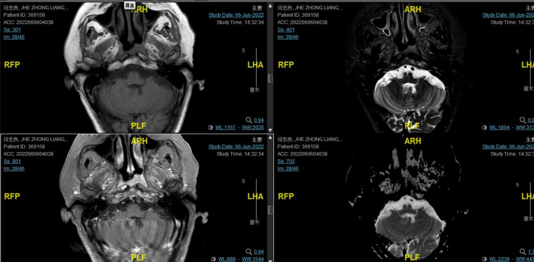 一例Ⅲ期鼻咽癌患者接受同步放化疗联合斯鲁利单抗治疗的经验分享