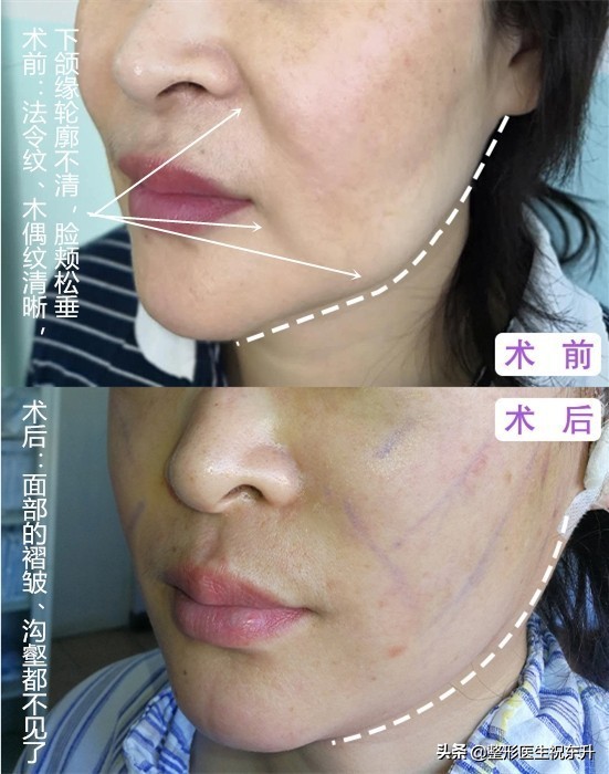 消除法令纹最有效的方法,脸上长法令纹怎么消除