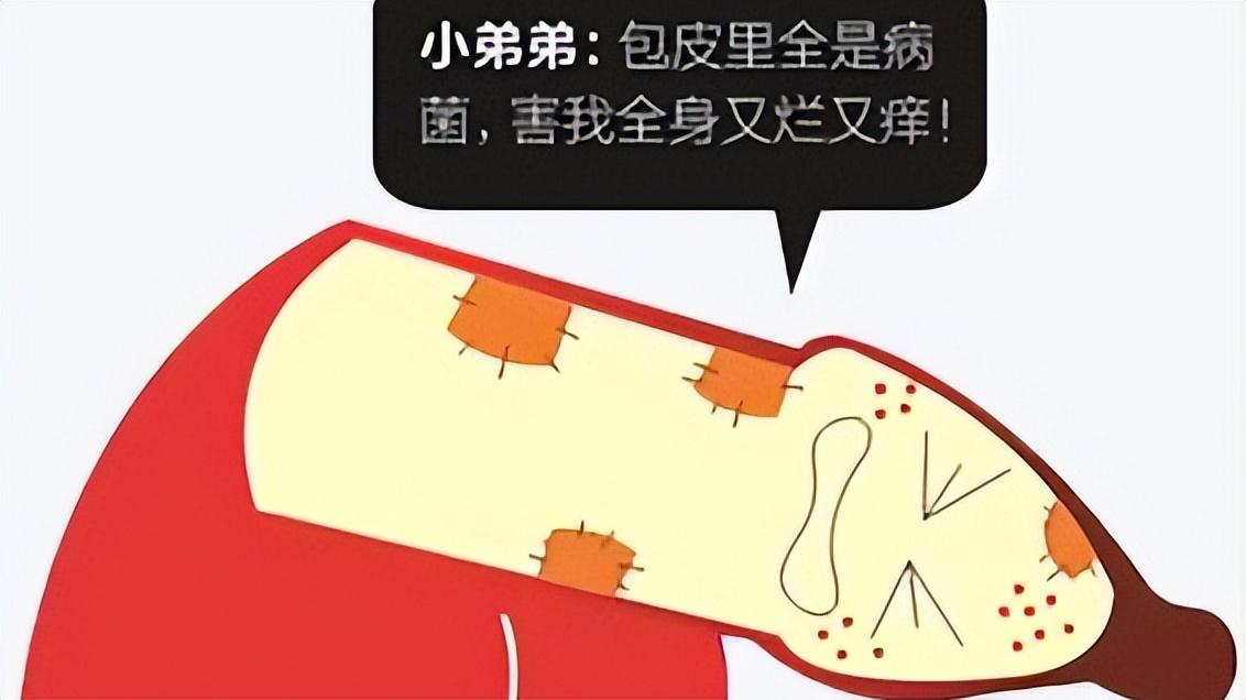 割了的包皮去哪了,28岁了包皮有必要割吗