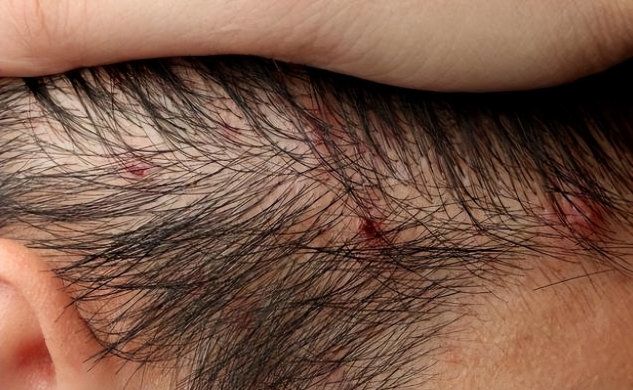 头皮起脓包疙瘩是怎么回事,头皮上全是疙瘩大脓包是什么原因