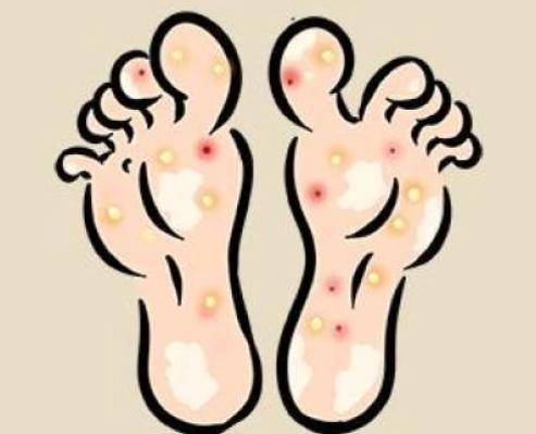日本人如何处理脚气问题,欧美人为什么更容易患脚气