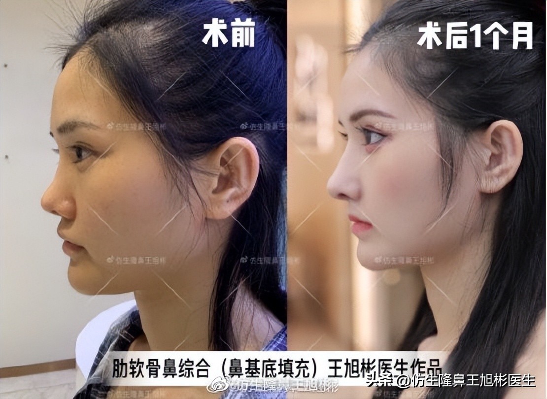 隆鼻鼻型科普,鼻基底凹陷隆鼻可以改善吗