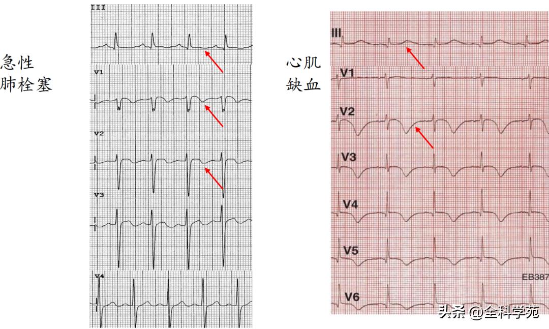 t波倒置三种常见原因,t波低平倒置有事吗