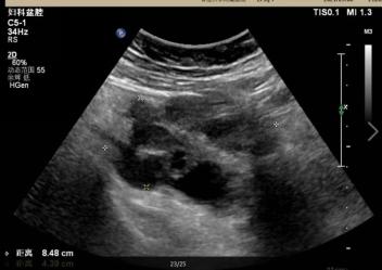 60岁女性患附件炎吃啥药有效,少女会得附件炎