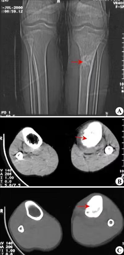12岁男孩右臂莫名疼痛，为了保命无奈截肢，谁知更大悲剧袭来