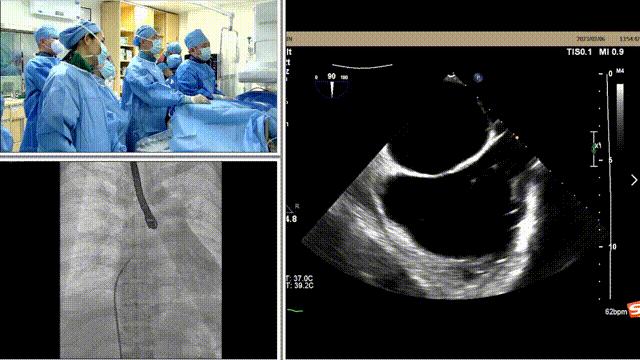 二尖瓣狭窄病例分享,二尖瓣病理生理及治疗方法