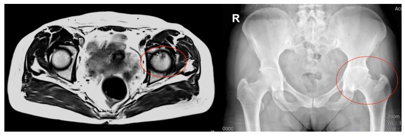 西安治疗股骨头坏死的土方法,西安红会医院股骨头坏死保守治疗