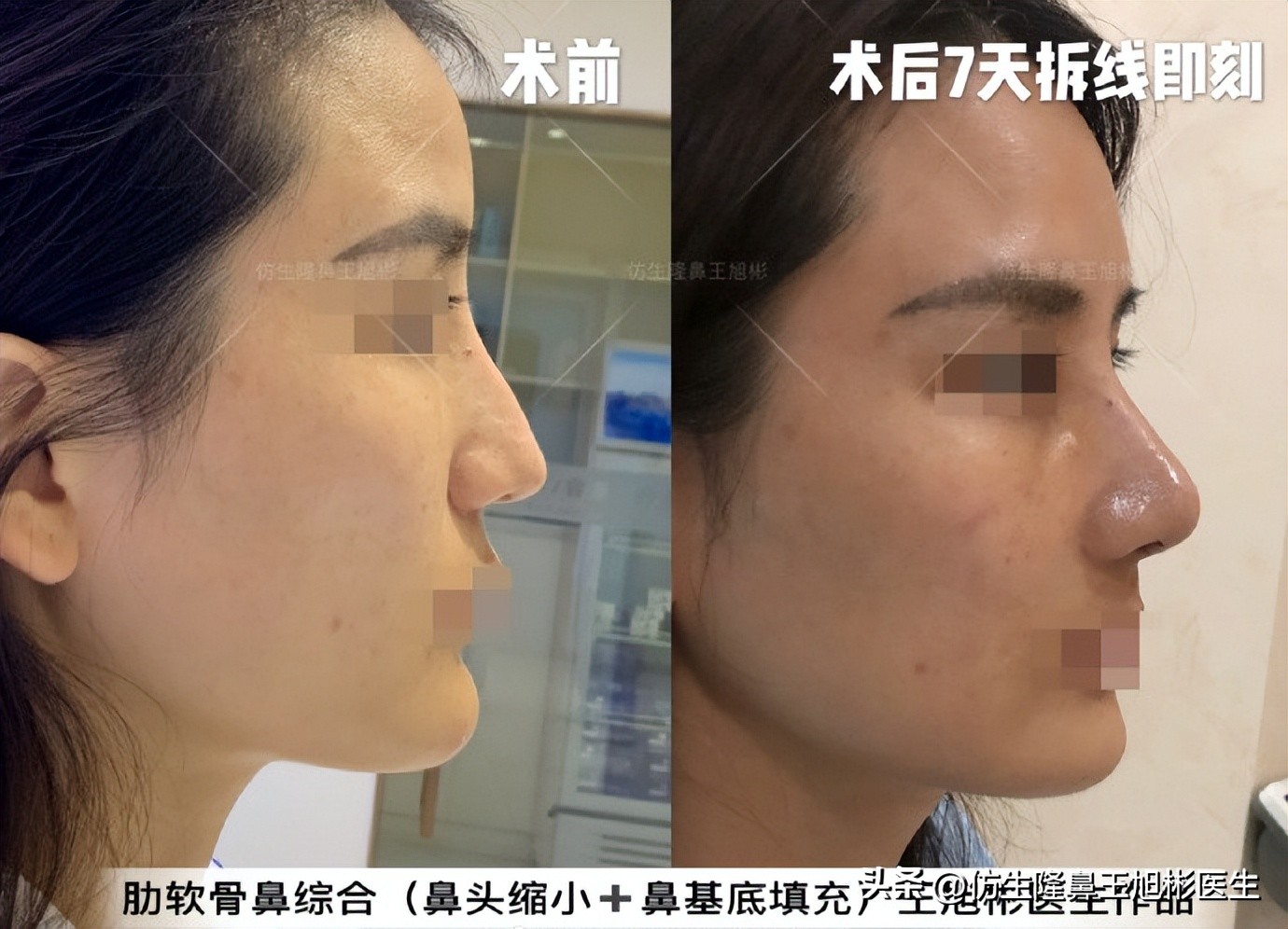 大鼻头能做直鼻微翘吗,可以只做鼻头缩小术吗