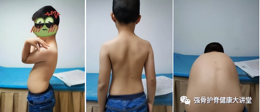 儿童脊柱侧弯治疗图,儿童脊柱侧弯最佳治疗方法