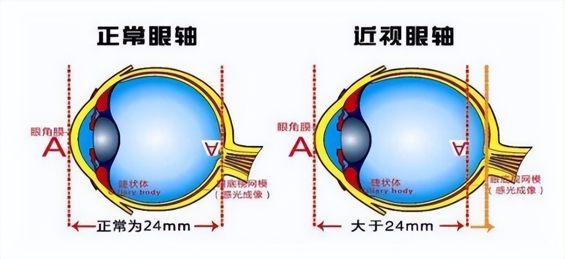 高度近视做手术后可以剧烈运动,高度近视可以剧烈运动吗