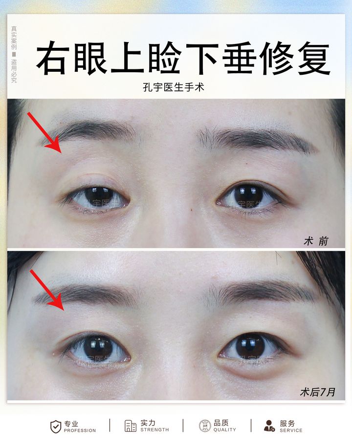 双眼皮术后大小眼是什么原因,双眼皮术后大小眼30天恢复图