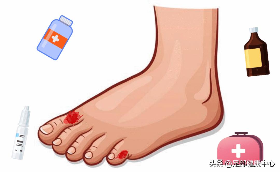 糖尿病患者需注意，新鞋磨脚可不是小问题，可能引发糖尿病足