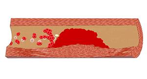 擤鼻涕千万别两个鼻子一起擤!这几天耳鼻喉科门诊里都是阳了后擤鼻涕擤出中耳炎的人“阳康”之后又有新烦恼