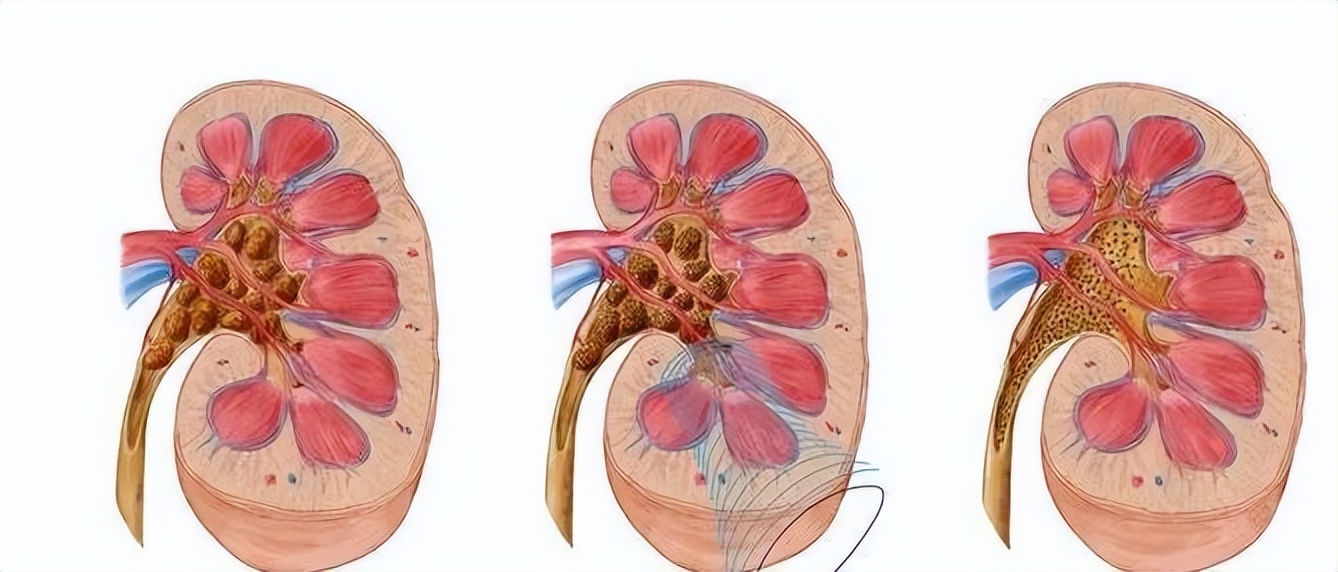 体检查出有肾囊肿和肝囊肿怎么办,体检时肾囊肿单位是毫米还是厘米